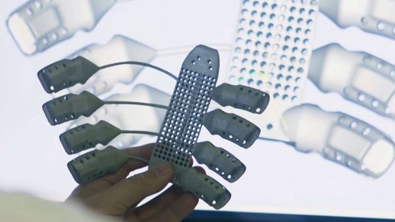 3D-s nyomtatóval készült titán mellkast kapott egy rákos beteg